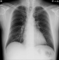 DR